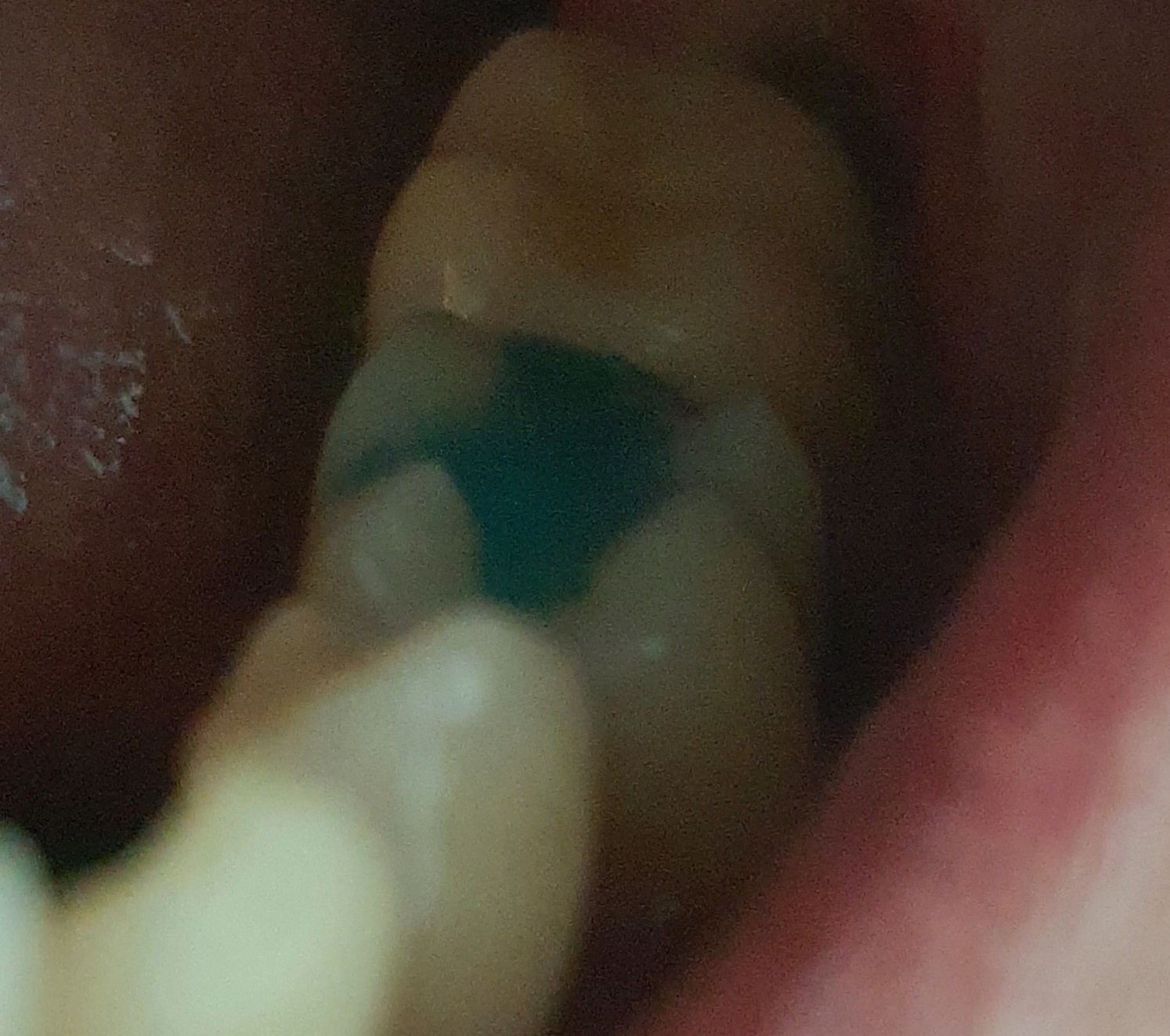 임시로 때운 나의 깨진 이빨