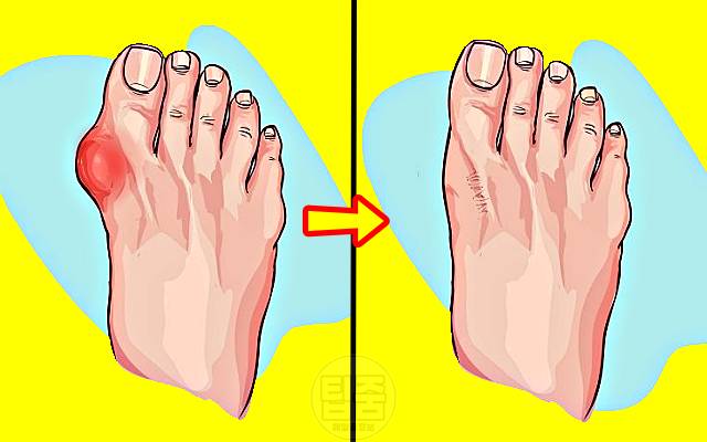 엄지발가락 옆 통증 건막류 치료 엄지발가락 휘어짐