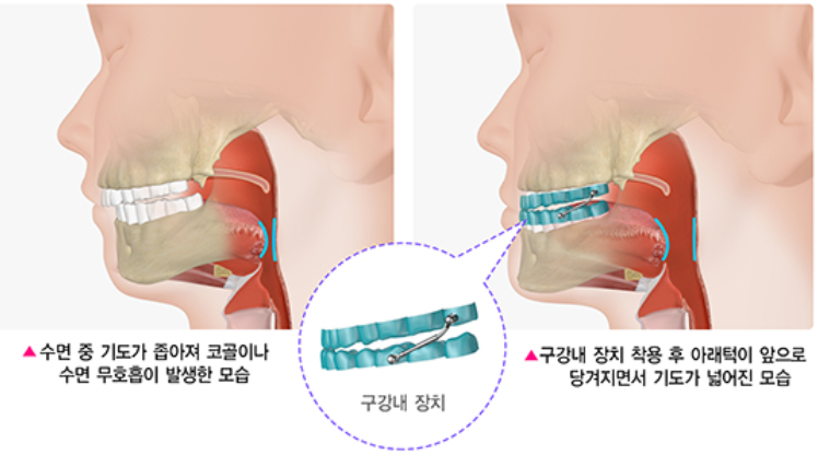 코골이 교정 장치