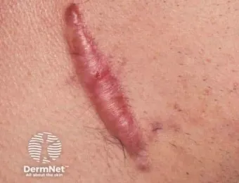 흉터전용 치료 추천 스카덤 겔 효능효과_3