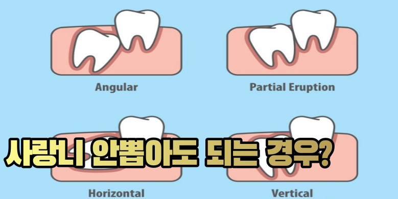 사랑니 안뽑아도 되는경우