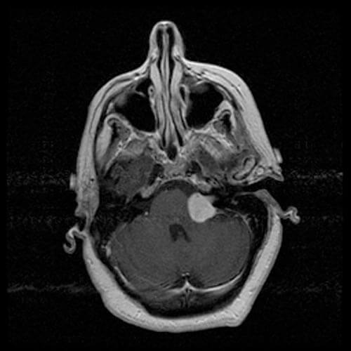 vestibular schwannoma X선 사진 