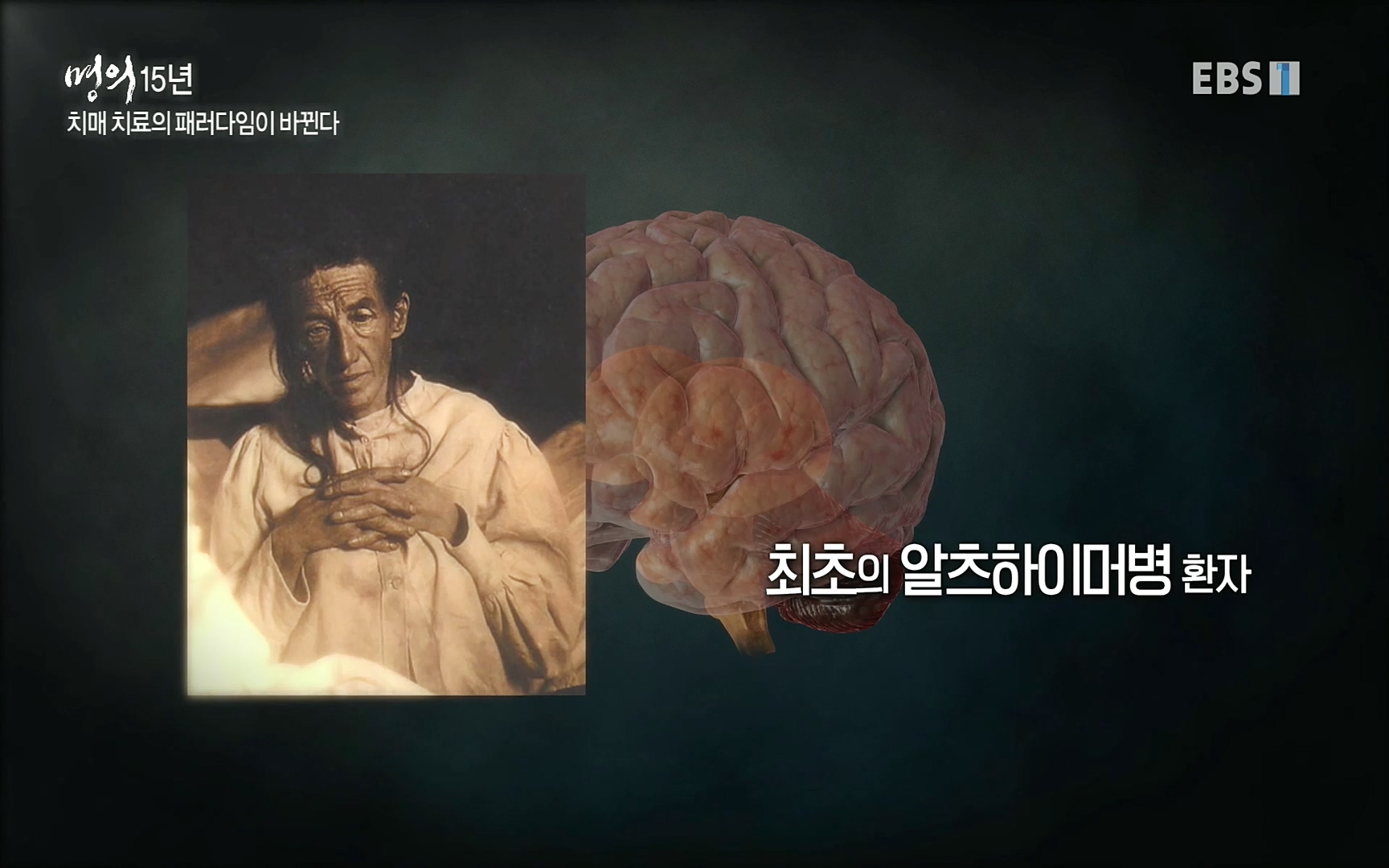 EBS 명의 헬스케어 - TV - 교육의 중심 EBS명의 15년 치매 치료의 패러다임이 바뀐다.mp4_20220808_204736.182.jpg