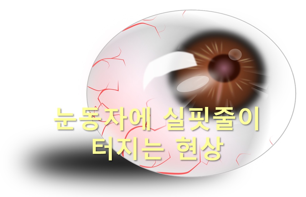  눈동자에 피멍이 들고 눈동자에 실핏줄 터지는 현상