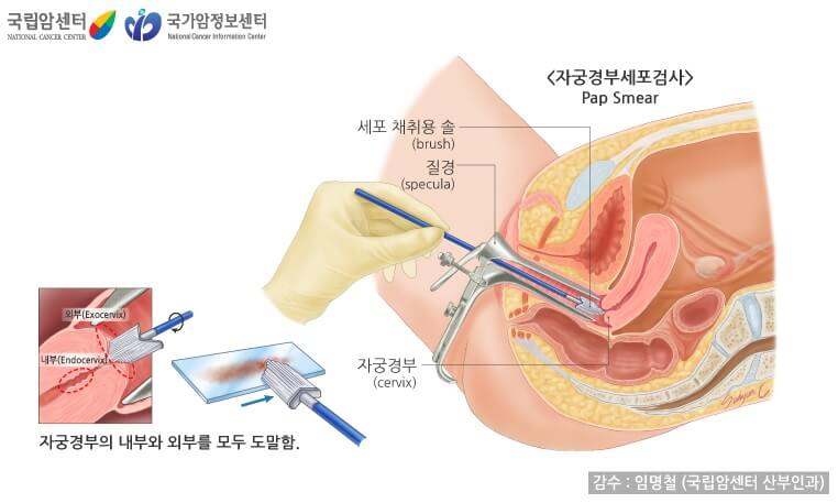 자궁 경부 세포학 - 설명