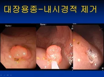 대장내시경 용종제거 후 식사 식단조절_7