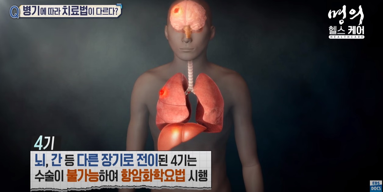 폐암4기 치료방법