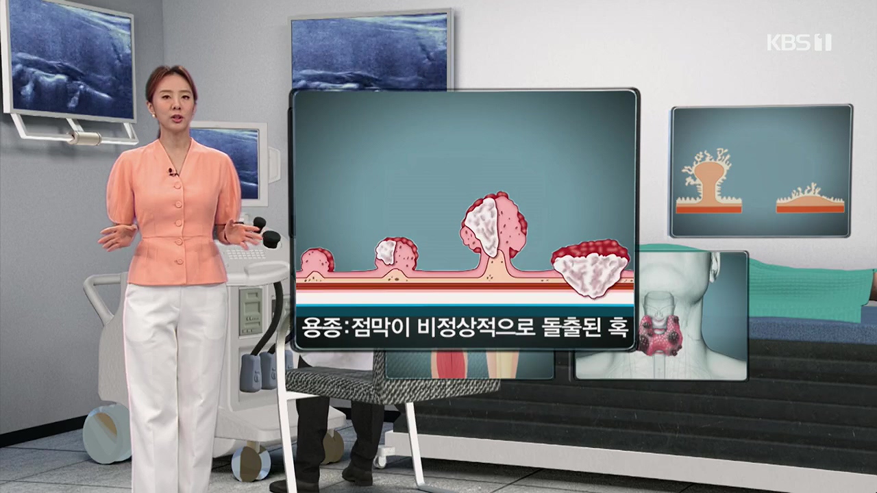 생로병사의 비밀.E870.230532p.H264-F1RST.mp4_20230605_195518.901.jpg