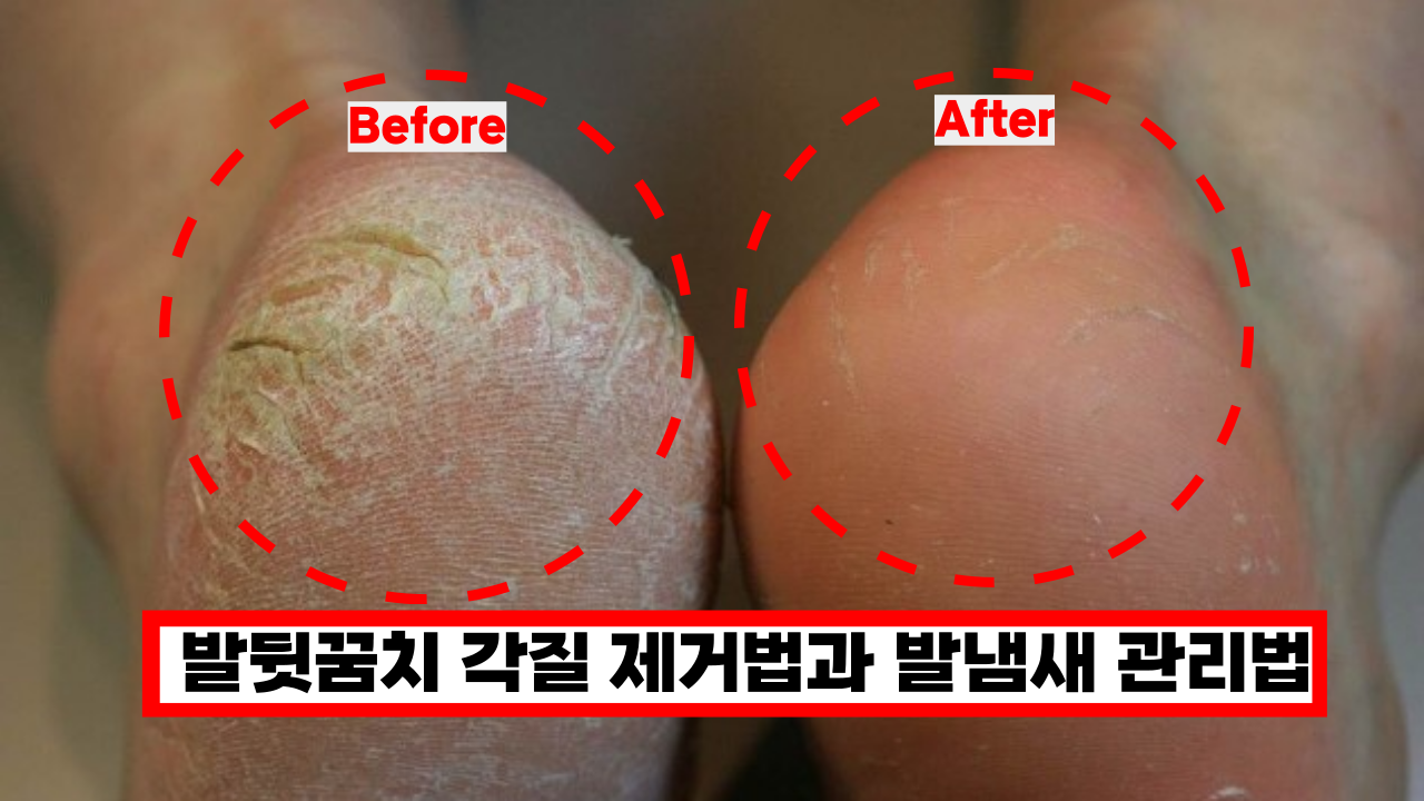  '샌들 신어야 하는데' 발각질, 냄새 제거에 효과적인 5가지 방법