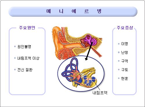 메니에르병 증상