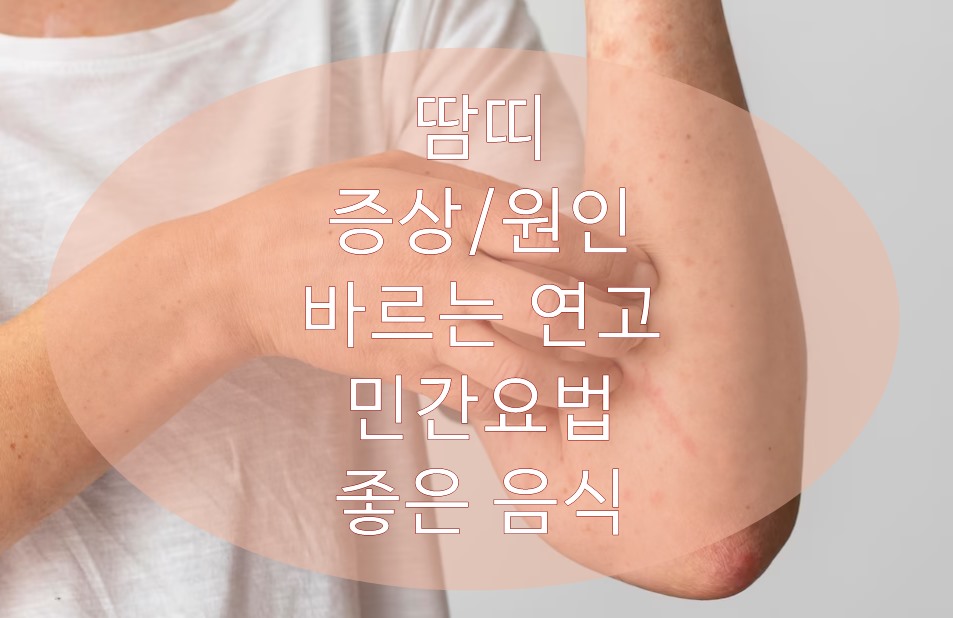 땀띠의 증상 및 원인 그리고 바르는 연고와 민간요법&#44; 좋은 음식