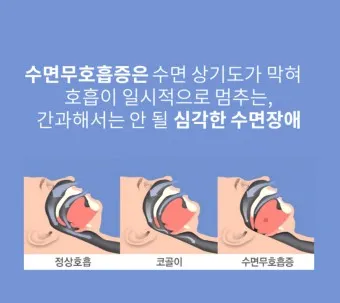 수면무호흡증 증상 원인 개선방법 치료법_12