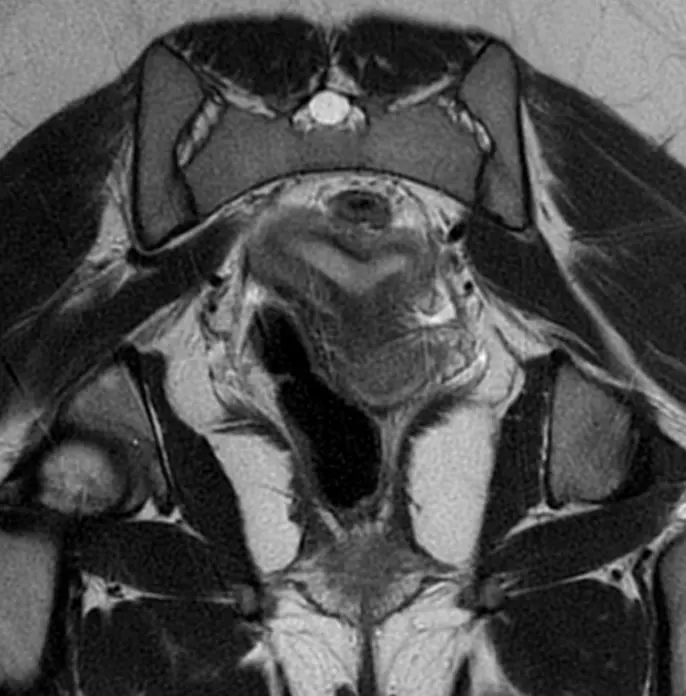쌍각자궁의 MRI