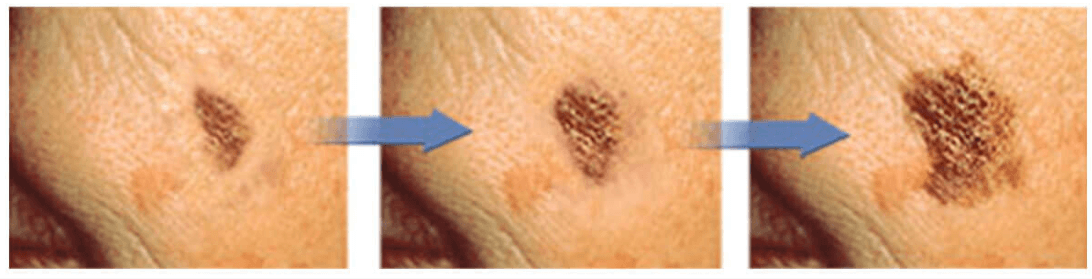 피부암 초기증상 흑색종