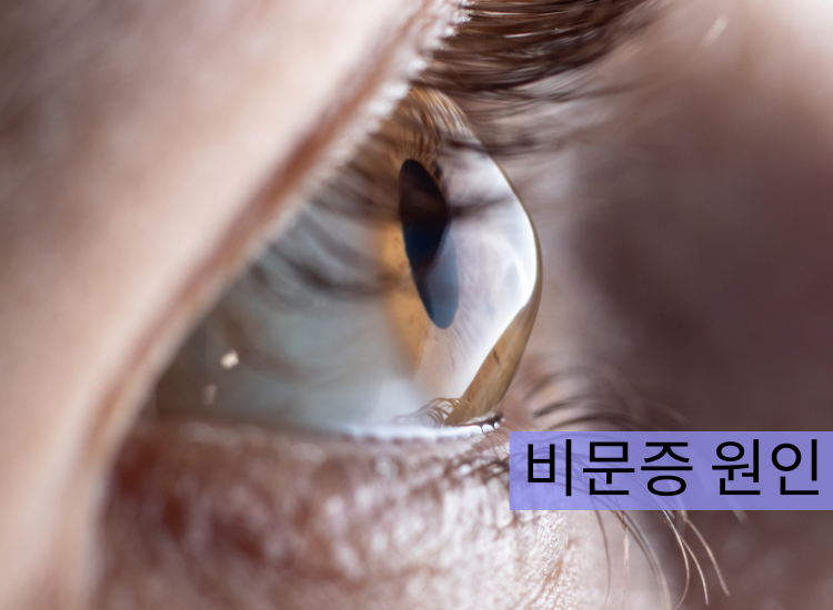 비문증 원인