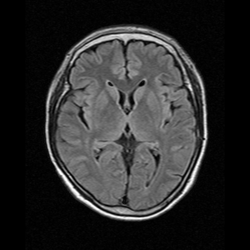 뇌-mri-t2-fatset-axial