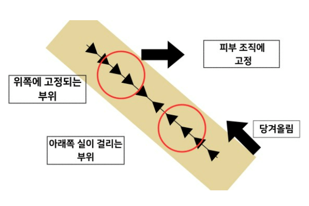 실리프팅 효과 가격 실리프팅 부작용