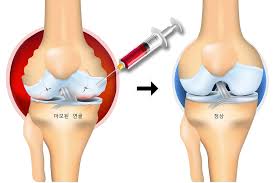 2025년 최신 무릎 연골 주사 종류 비교! 어떤 주사가 내 무릎에 맞을까?