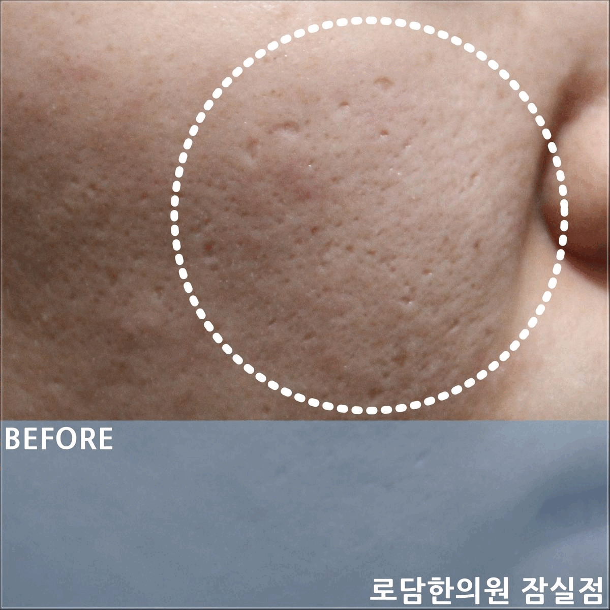  건대 여드름 흉터 피부과가 아닌 한의원에서 새살침으로
