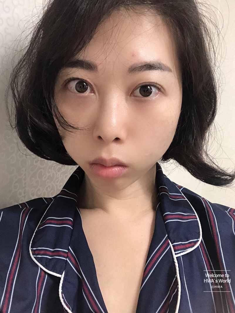 콧볼 축소 비용 [강남/보톡스] 콧볼축소주사-후기 13