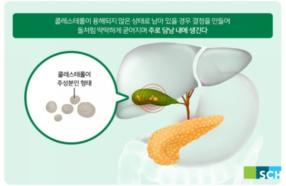 소변동반. 비만의 경우 담석의 위험성이 높고 [담석] 폐쇄성 황달, 담석증이 심한 경우 황달이나 황색