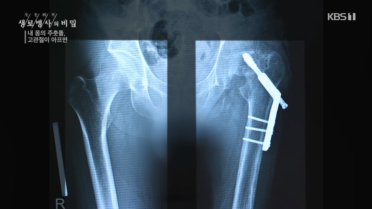 생로병사의 비밀.E890.231116p-NEXT.mp4_20231116_204848.481.jpg