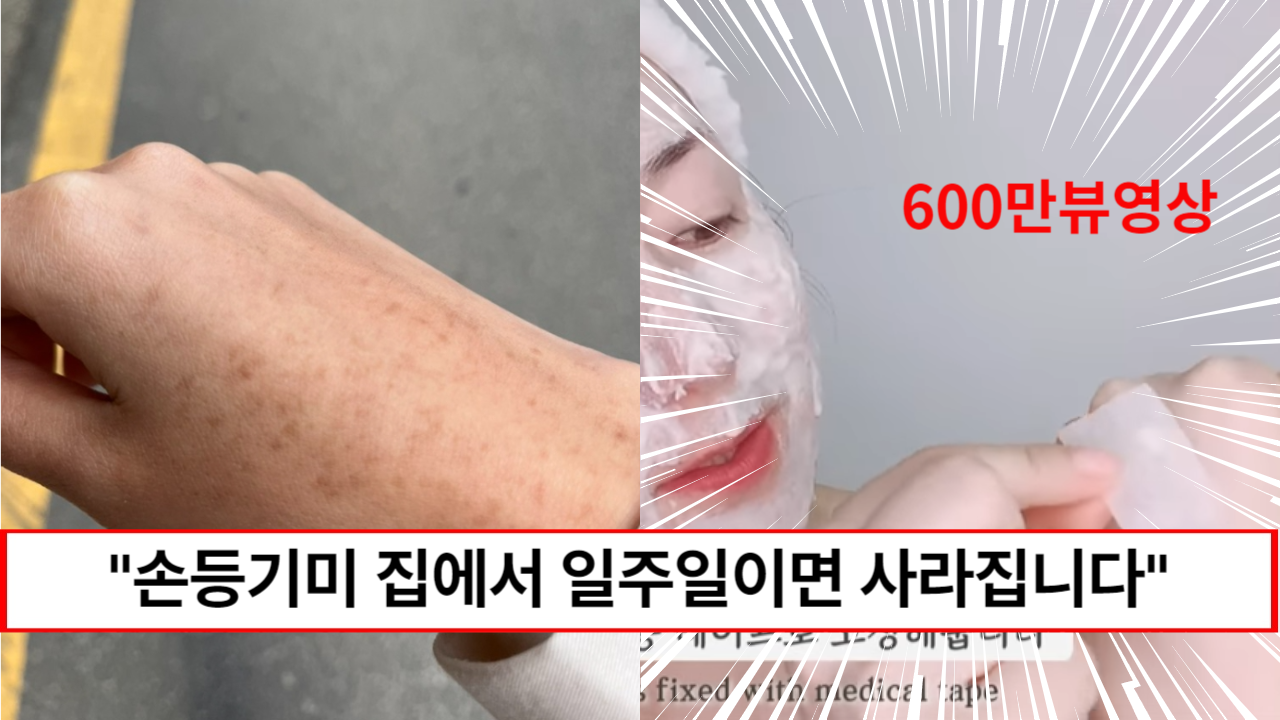 “600만뷰 영상이 보장합니다” 집에서 일주일이면 손등기미를 싹 없앨 수 있는 재료 2가지