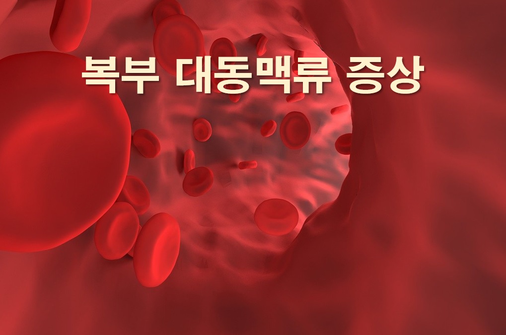  복부 대동맥류 증상과 복부 대동맥류 수술 방법