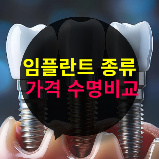 임플란트 종류별 특징, 비용, 수명 비교와 선택 팁