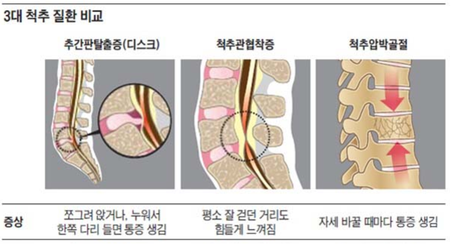 척추관협착증 증상 요통과 다리저림의 원인