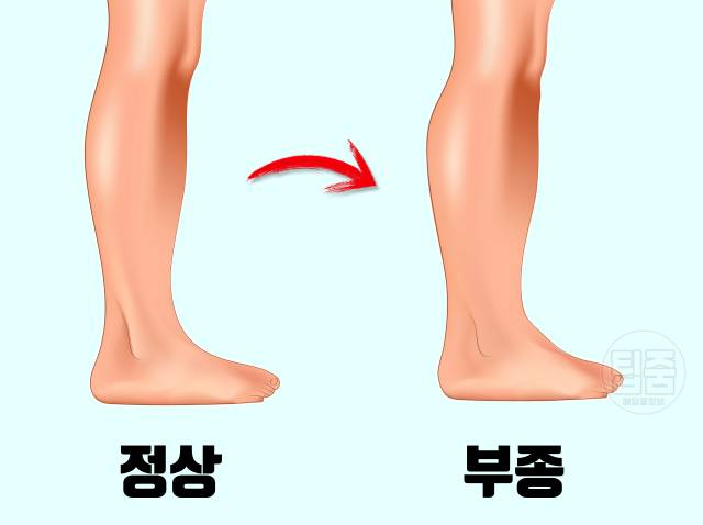 몸 혈액순환 안되면 나타나는 증상,붓기