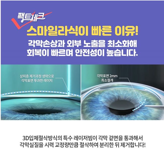 스마일라식가격 비교 기준 체크 확인!