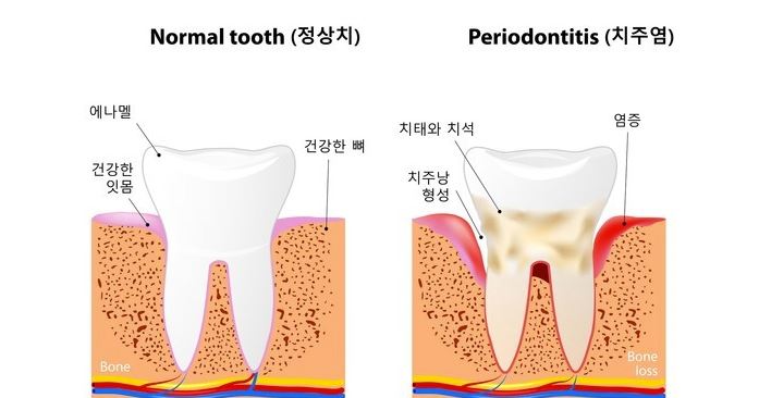  워터픽 구강세정기 치석/치주염 예방을 위한 필수품