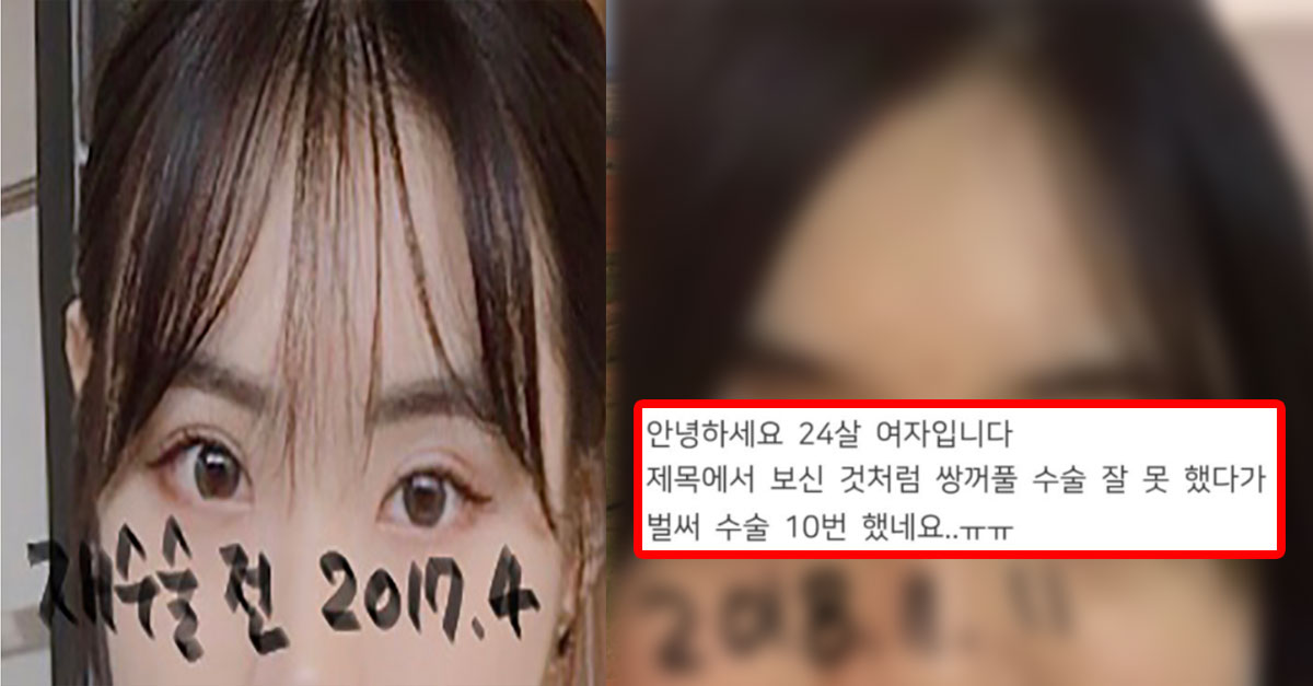  쌍꺼풀 재수술만 10번 한 사람의 눈 상태..