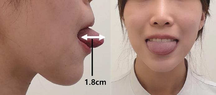 수술 없이 수면 무호흡증과 코골이를 개선하는 방법