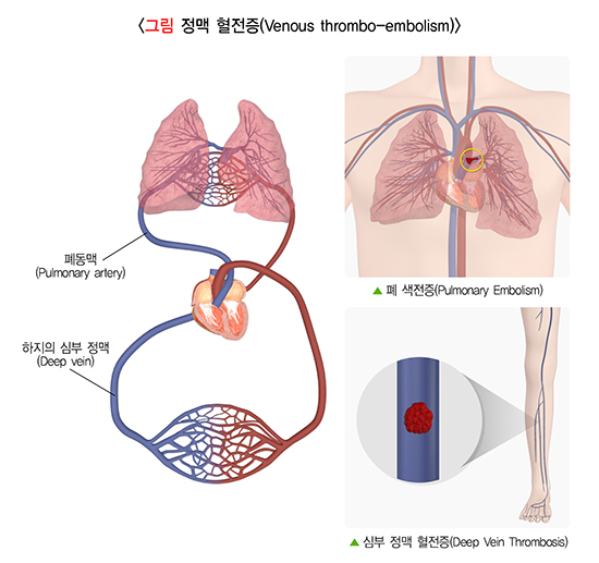  폐 색전증