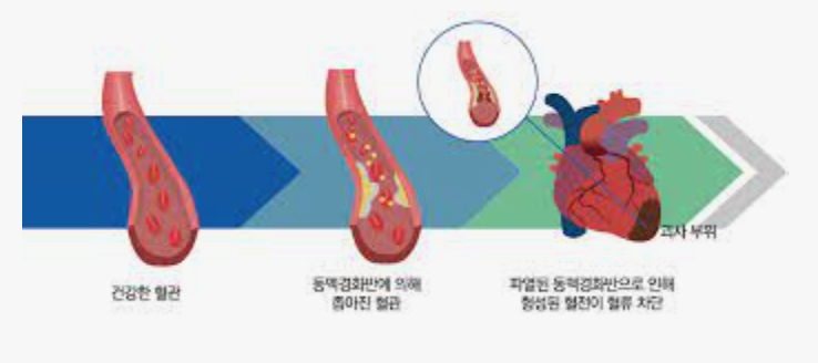 심근경색 원인 및 예후 예방 방법