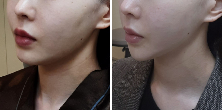  울타늄 리프팅? 효과좋은 병원은 ㅇㅇ때문입니다!