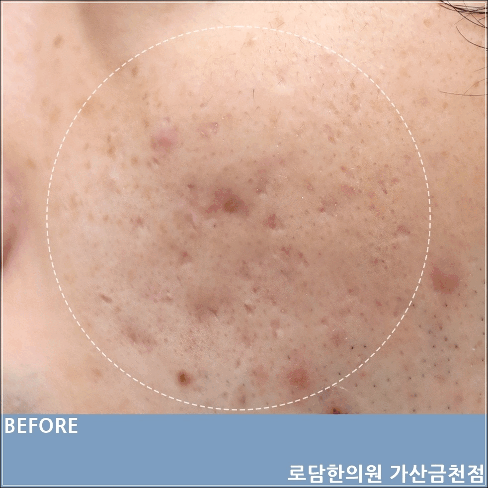  가산 여드름 흉터 관리 과정 로담한의원 새살침으로 제거를