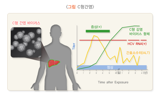  C형간염