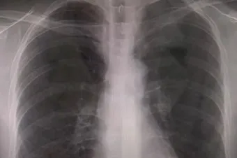 잠복 결행 양성일때 치료하는 방법_21
