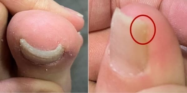 교정할발톱
