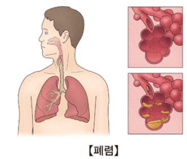 폐렴-종류2