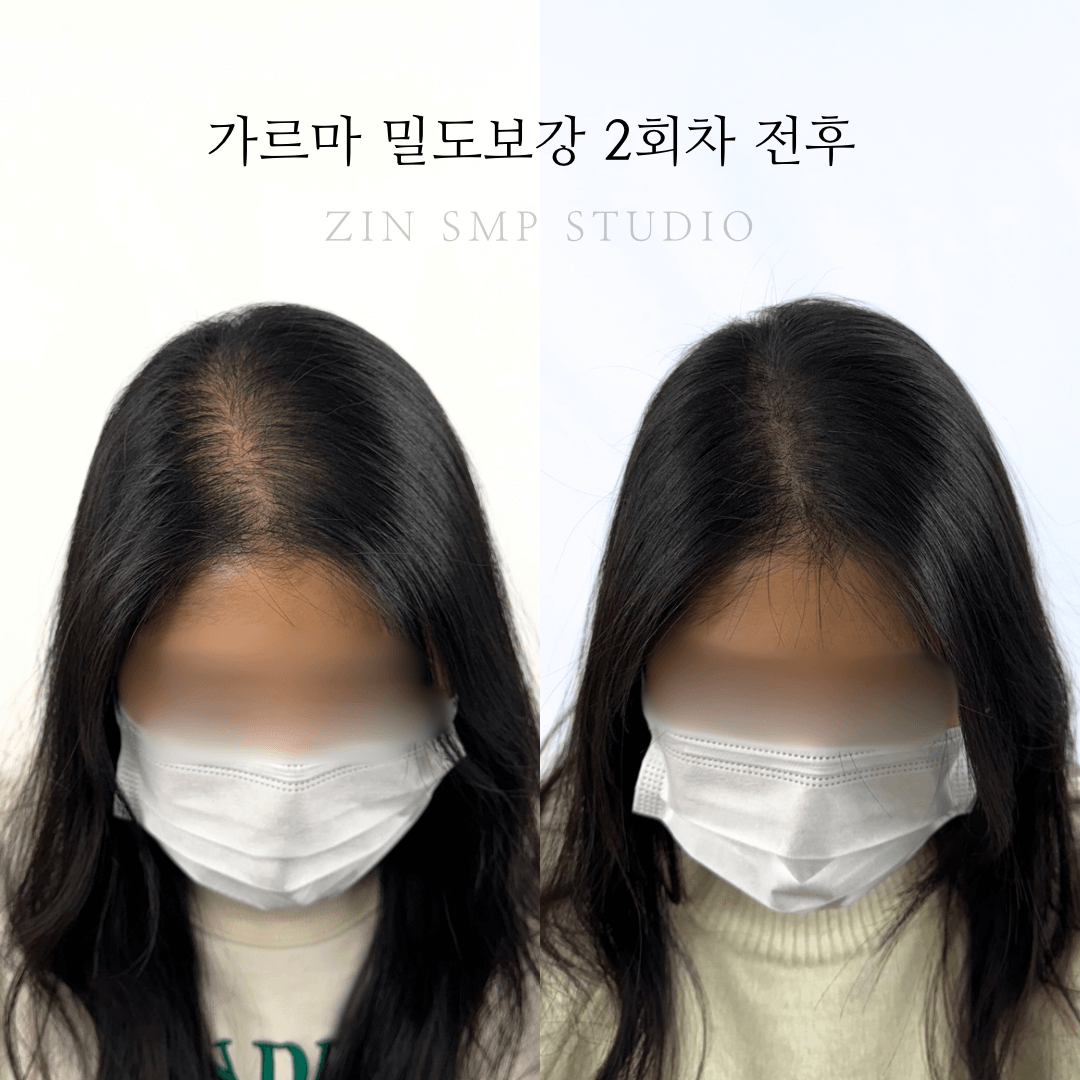 두피문신 잘하는 곳