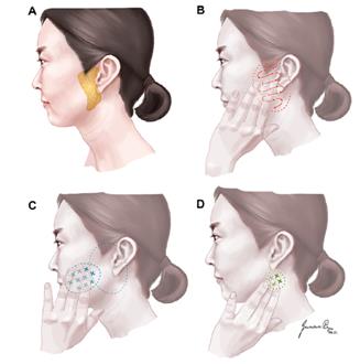 귀밑 멍울, 턱밑 멍울 이미지