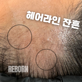 선헤어라인 이미지