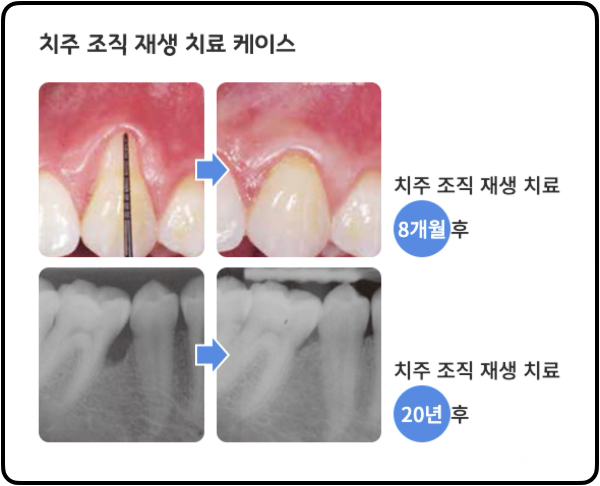 엠도게인 치료 사례