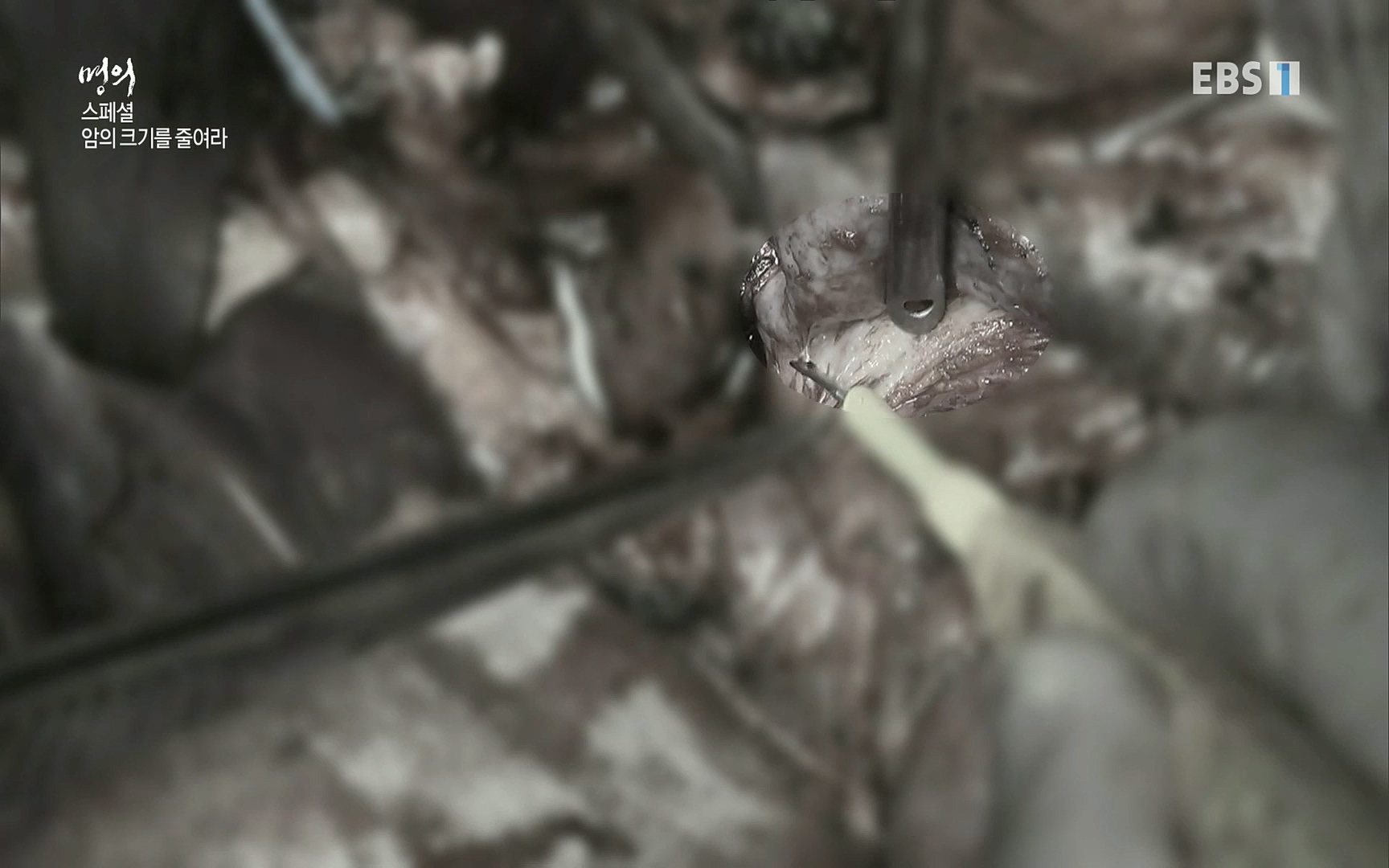 EBS 명의 헬스케어 - TV - 교육의 중심 EBS[명의 스페셜] 공포의 암, 췌장암, 담도암, 담낭암.mp4_20220902_210908.620.jpg
