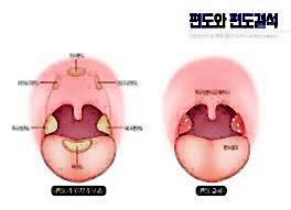 편도결석-이미지