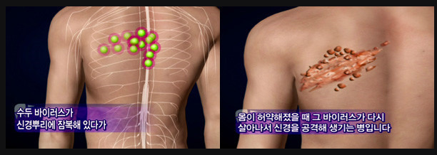  대상포진 증상 전염성 알아보고 예방하기